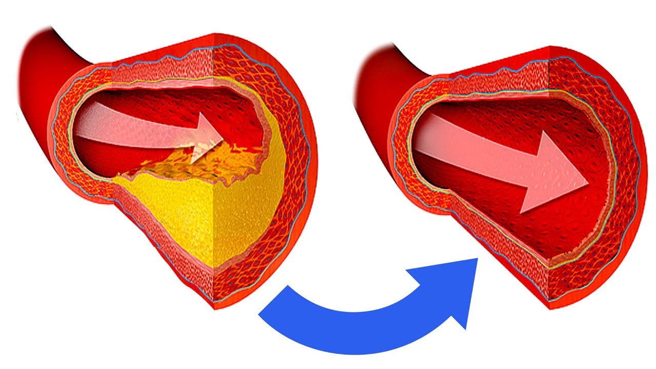 Чистка артерий. Грязные сосуды прочищают. Прочистка сосудов через Вену. Какие вещи расширяют сосуды.